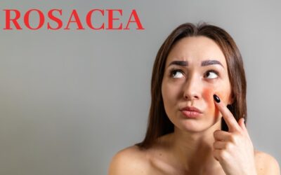 3 Questions Answered About Rosacea