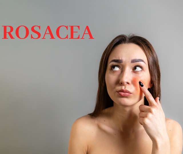 3 Questions Answered About Rosacea
