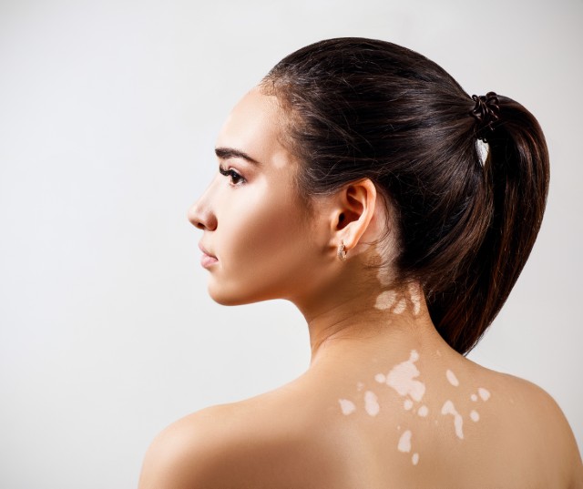 Vitiligo: 3 Common Myths Busted!