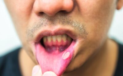 4 Questions Answered About Mouth Ulcers!