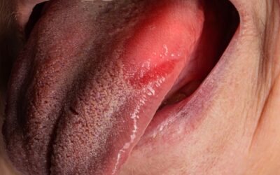 What Is Burning Mouth Syndrome? 4 Causes of Burning Mouth Syndrome You Should Know!